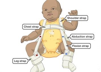 Children's Hip Joint Dislocation of Hip Abduction Orthosis Child Hinged Hip  Abduction Brace Hip Dysplasia Corrector,S